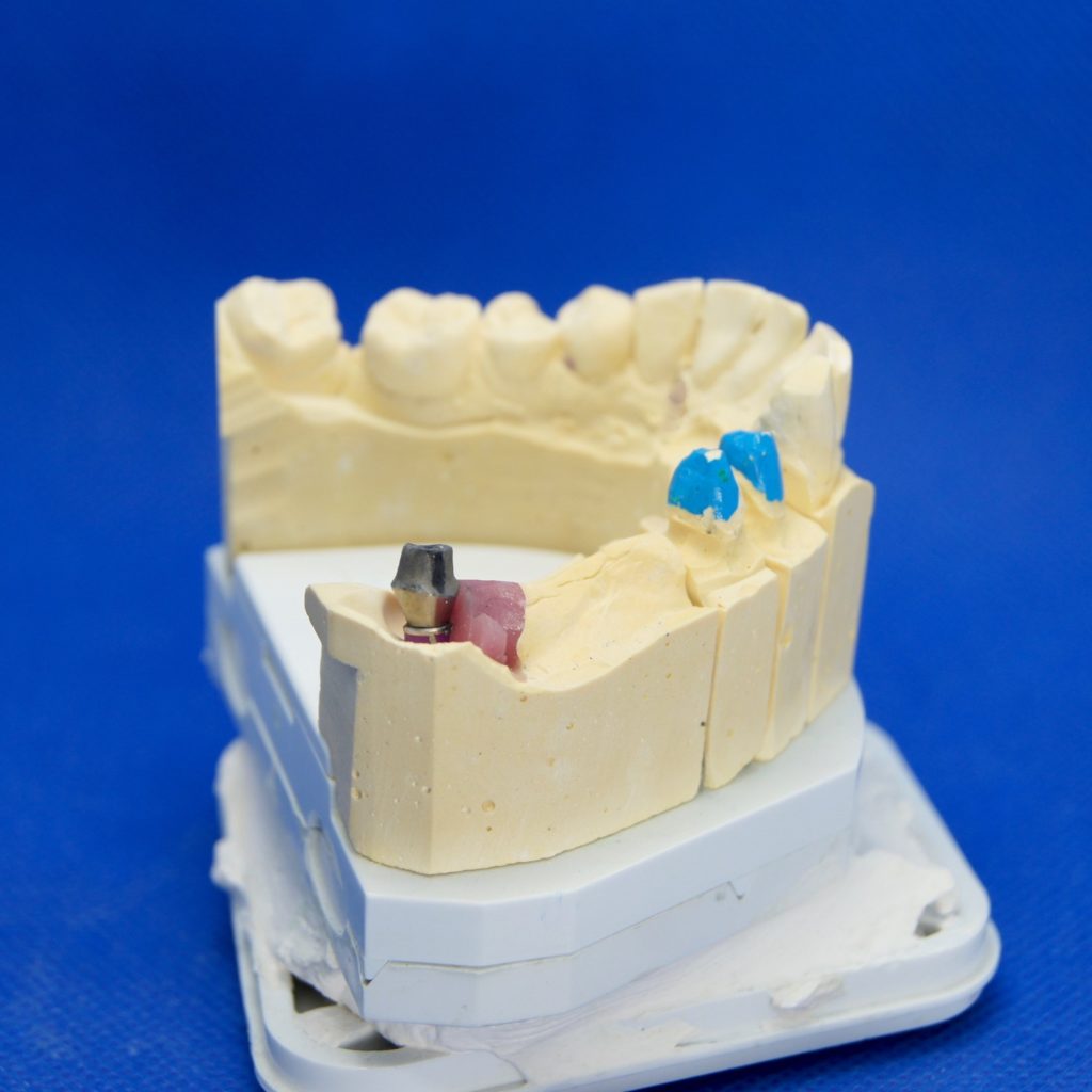 Brücke auf Implantat und Eigenzähnen Zahnersatz