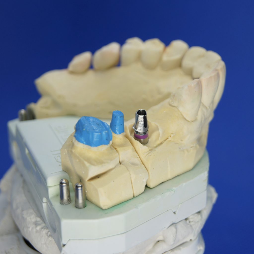 Implantate Zahnersatz Kronen Neuenhagen
