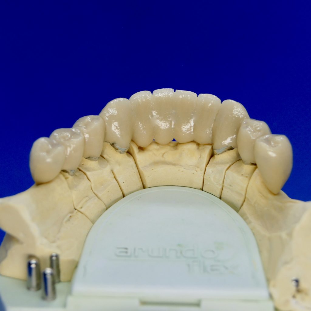 Zahnersatz Kronen Implantate Neuenhagen