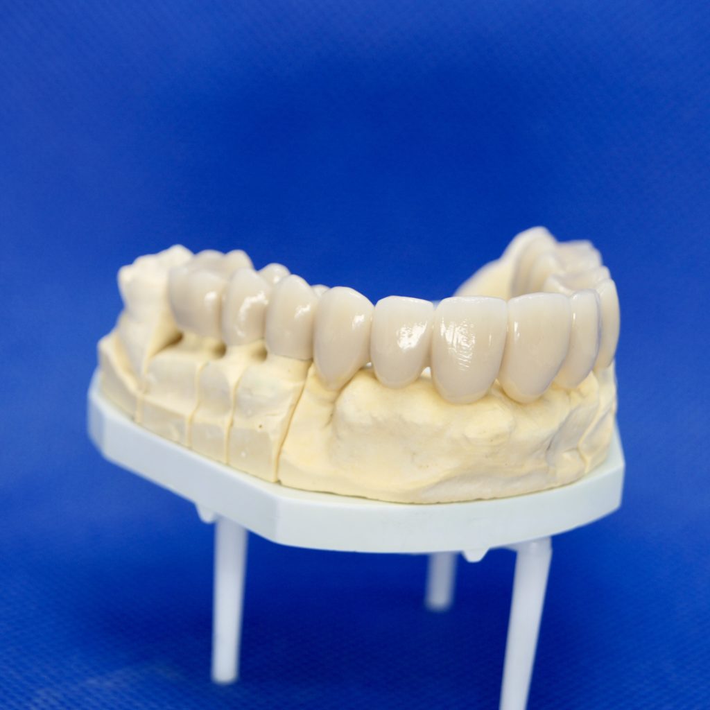 Zahnersatz Kronen Implantate Neuenhagen Dentallabor