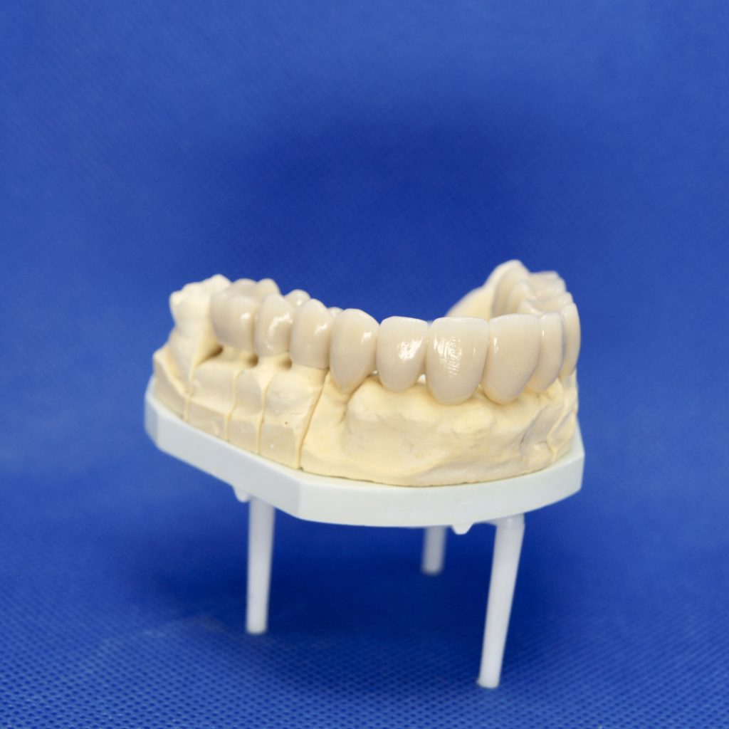 Zahnersatz Kronen Implantate Neuenhagen Dentallabor